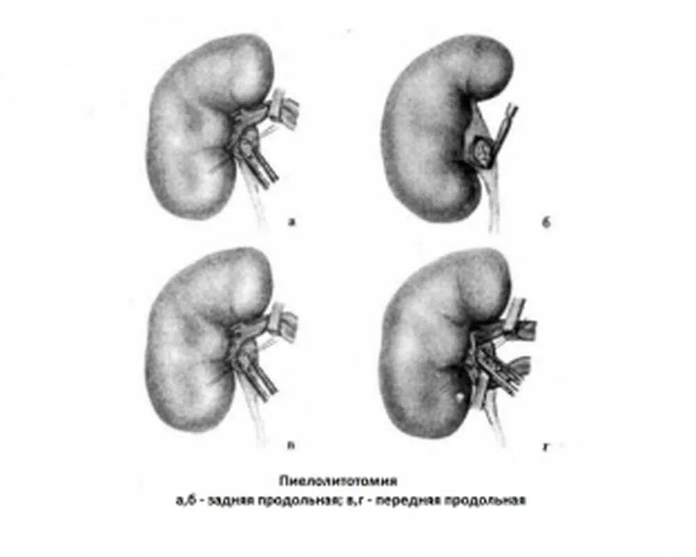 Гидрокаликоз почек патанатомия. Двусторонний гидрокаликоз почек. Резекция почки лапа. Резекция почки что это
