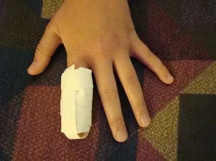 Broken finger