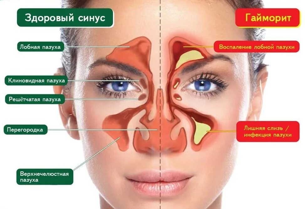 Болит ли гайморит