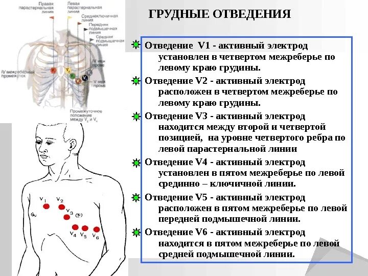 Экг куда накладывать электроды