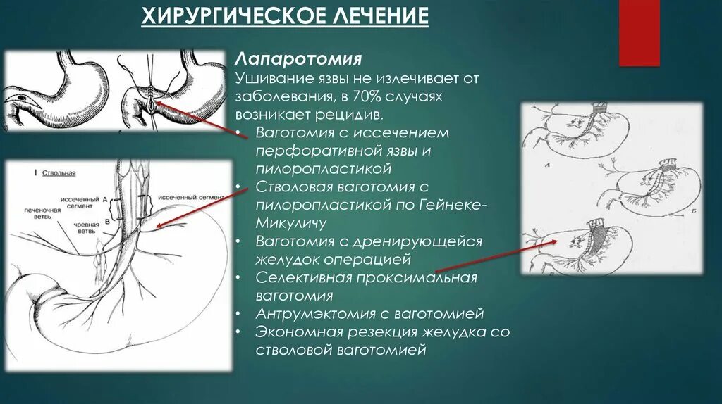 Резекция желудка махачкала. Лапаротомия, ушивание перфоративной язвы дпк. селективная ваготомия желудка. трункулярная ваготомия. стволовая ваготомия с пилоропластикой.