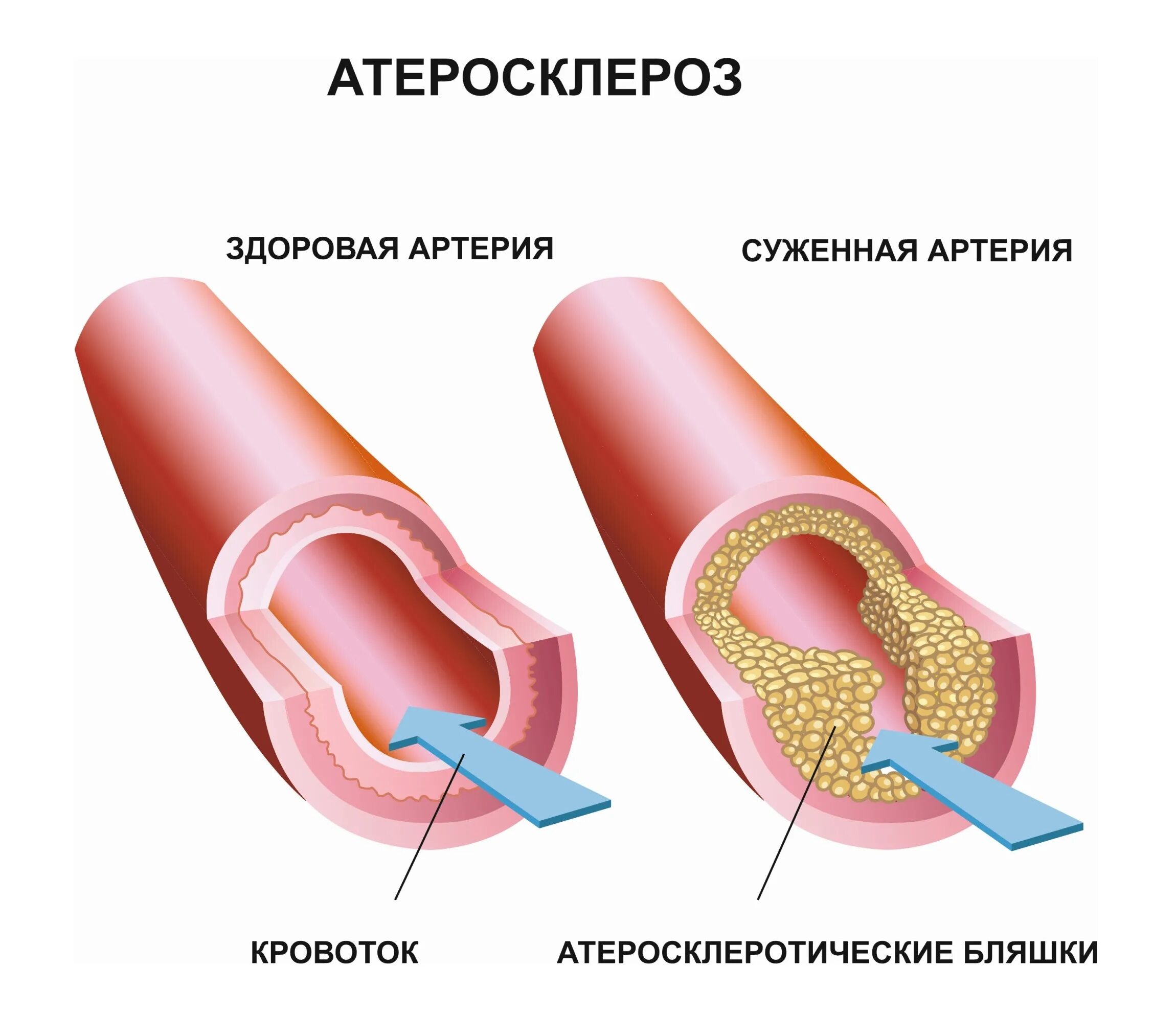 Атеросклеротические бляшки в сосудах. Тромб и бляшка разница