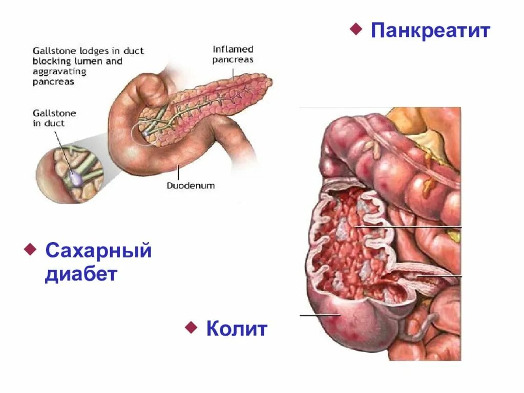 Два вида пожилых людей. Колит при сахарном диабете. Колит при сахарном диабете. Диабет уколы. Сахарный диабет 1 типа фото.