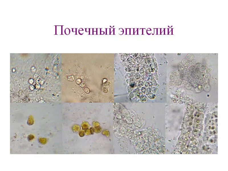 Микроскопия мочи клетки почечного эпителия. Микроскопия осадка мочи почечный эпителий. Плоские клетки почечного эпителия в моче. Плоский и неплоский эпителий в моче. Повышенный эпителий в моче у мужчин