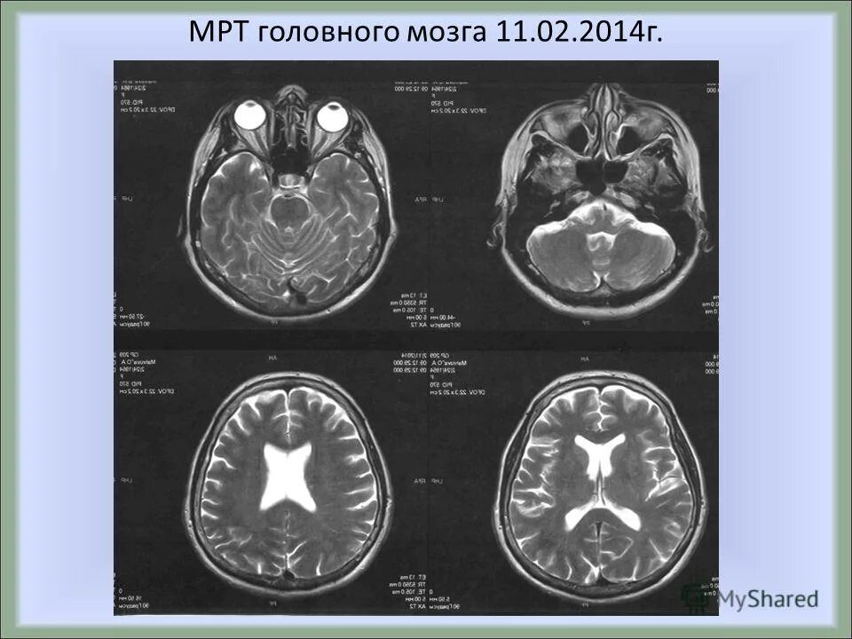 мрт позвоночника аксиальный срез. мрт головного мозга в боковой проекции. мрт результаты исследования. Dwi мрт. Dwi adc.