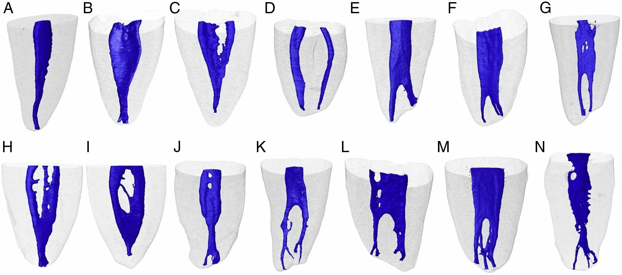 Классификация корневых каналов Vertucci. Топография корневых каналов 16 зуба. Конфигурация корневых каналов по Вертуччи. Зуб 3.6 анатомия каналов.