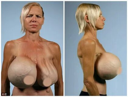 The woman with 20-year old, 13.5kg silicone breast implants.