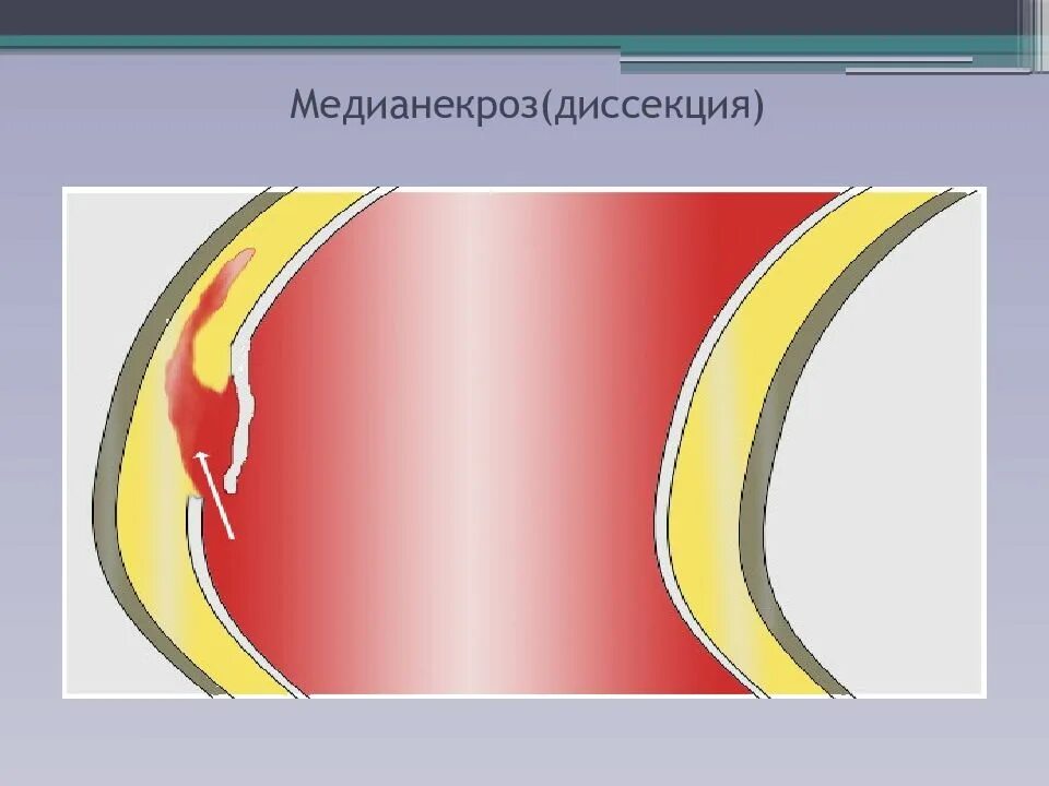 Диссекция вса