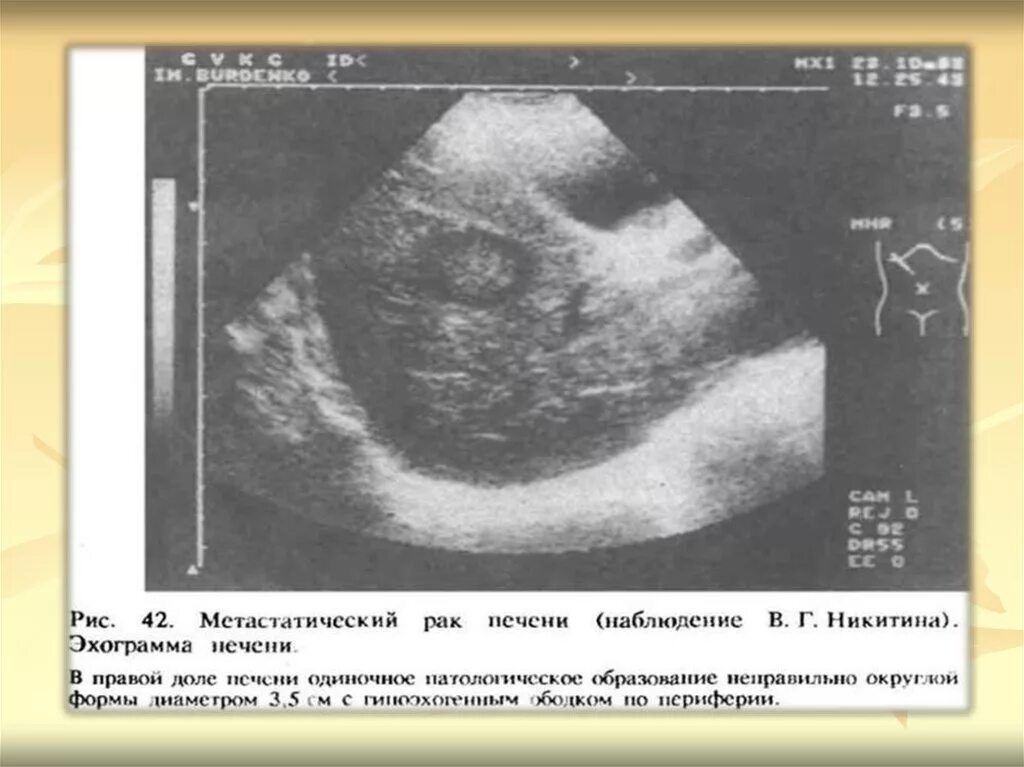 Рак печени стадии прогноз. Метастатическая карцинома печени. Метастатическое поражение печени УЗИ. Метастатические опухоли печени.