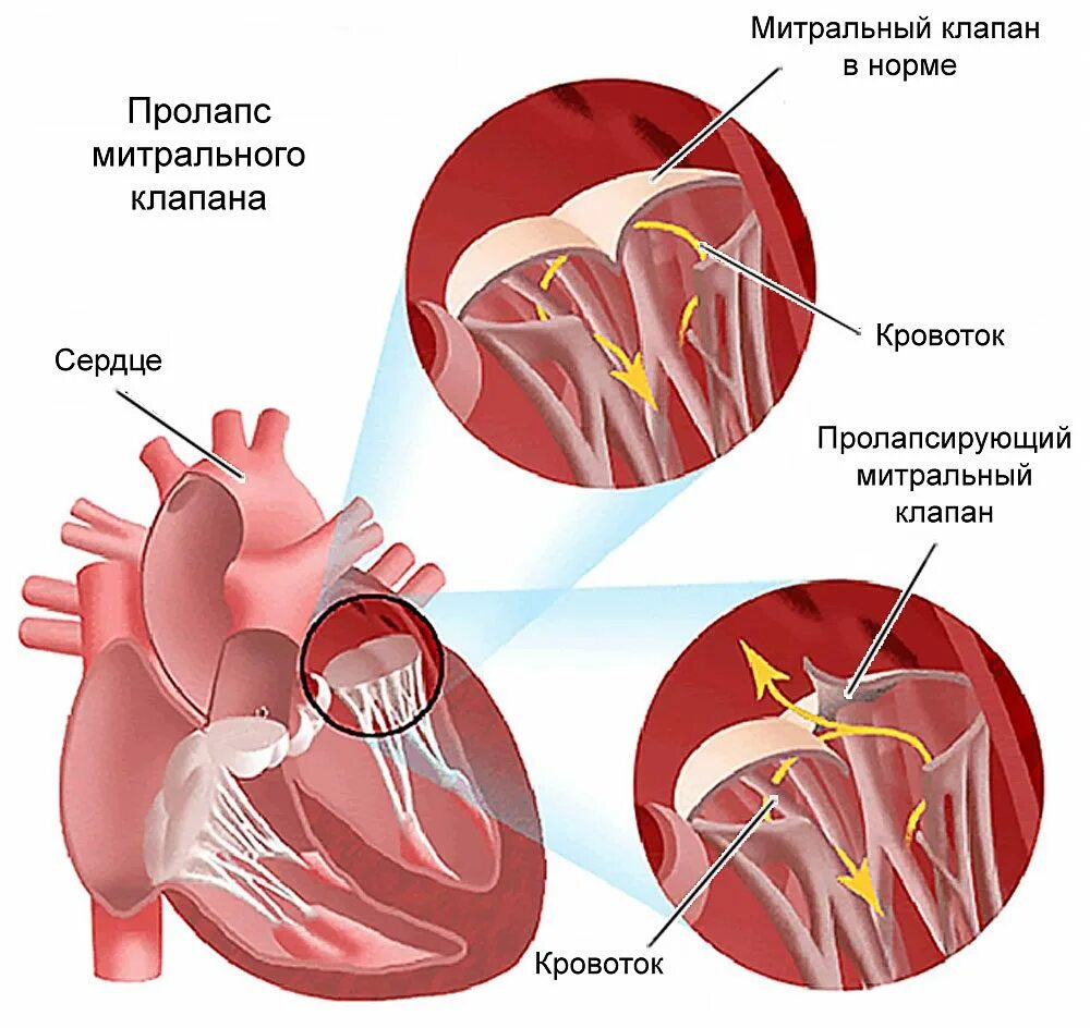 Марс в кардиологии. Параллакс митрального клапана 1 степени. Пролапс митрального клапана сердца. Пролапс передней створки митрального клапана 1. Пролапс митрального клапана хорда.