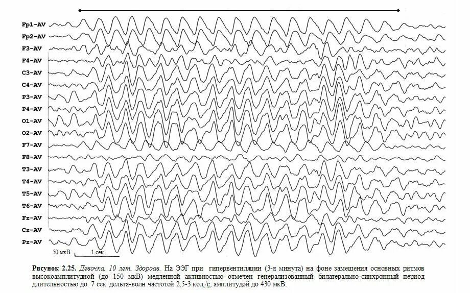 Активность ээг у ребенка что это. Дельта активность на ЭЭГ У взрослых. Вспышки Дельта волн на ЭЭГ. Дельта активность на ЭЭГ У детей. Тета волны на ЭЭГ.