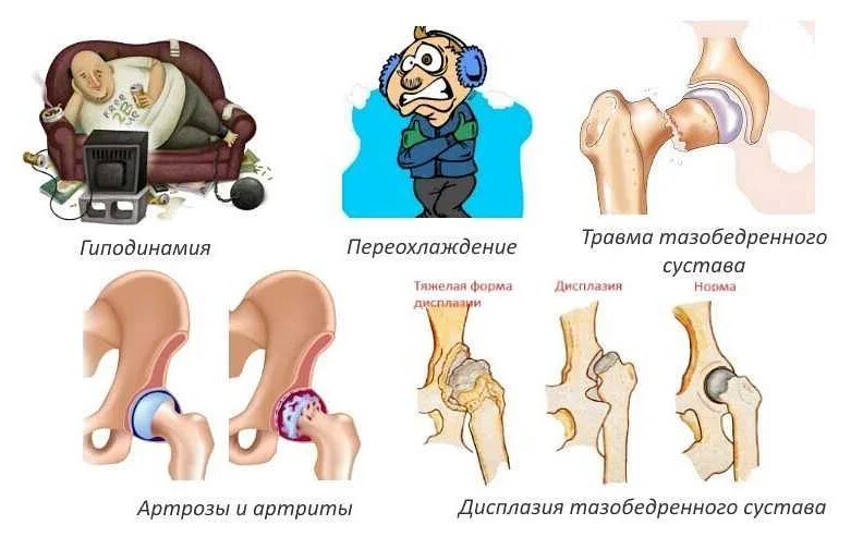 Тазобедренный сустав симптомы болезни. Синовиальные сумки тазобедренного сустава. вертельный бурсит тазобедренного. вертельная сумка тазобедренного сустава. суставная сумка тазобедренного сустава.