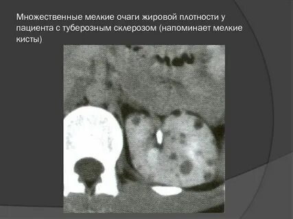 Очаг в печени форум