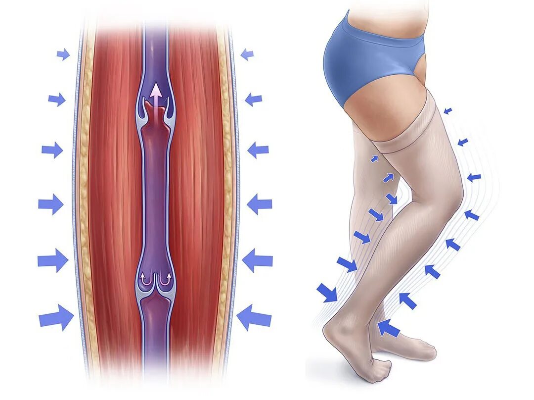 Послеоперационный тромбоз. Варикозное расширение вен (ВРВ) нижних конечностей. Эластическая компрессия нижних конечностей. Компрессионный трикотаж при варикозе. Компрессионная терапия нижних конечностей.