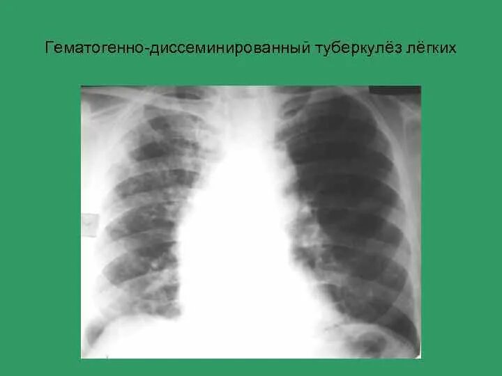 Диссеминированный туберкулез легких фазы. Подострый диссеминированный туберкулез рентген. Острый диссеминированный туберкулез рентген. Диссеминированный инфильтративный туберкулез. Гематогенно диссеминированный туберкулез рентген.