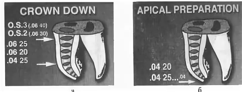 Crown down техника в эндодонтии. Step down техника в эндодонтии. техника crown down в эндодонтии этапы. техника crown down в стоматологии. методика степ бэк краун даун.