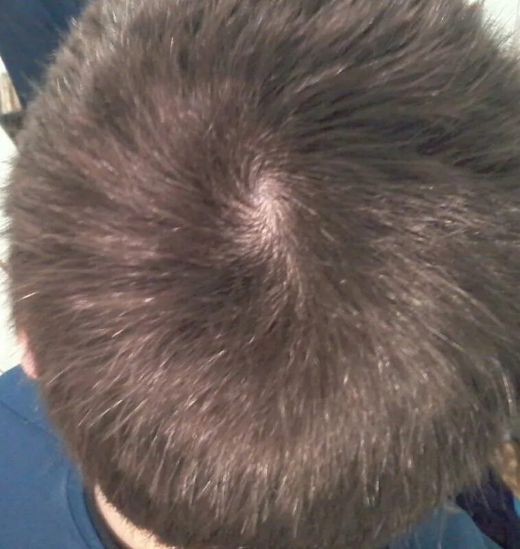 что значит две макушки у мужчины