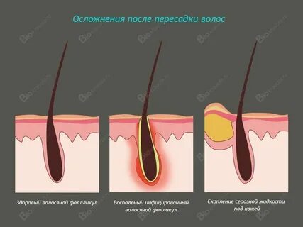 Температура после пересадки
