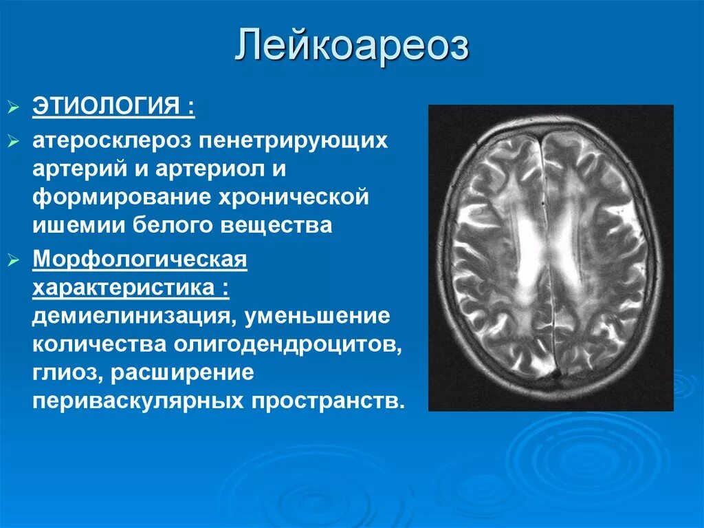 Признаки дисциркуляторных изменений. Лейкоэнцефалопатия неврология. Перивентрикулярный лейкоареоз. Кт признаки лейкоареоза головного мозга. Лейкоареоз кт протокол.