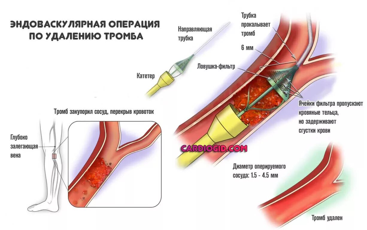 Как открыть сосуды