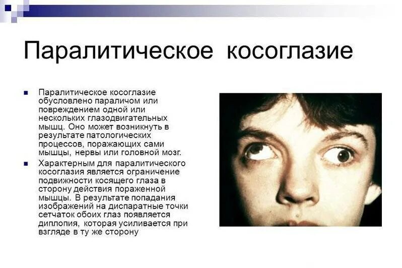 Косоглазие симптомы. Крсоглазие назалетичечкое. паралитическая косоглазип. паралитическое расходящееся косоглазие. паралитическое вертикальное косоглазие.