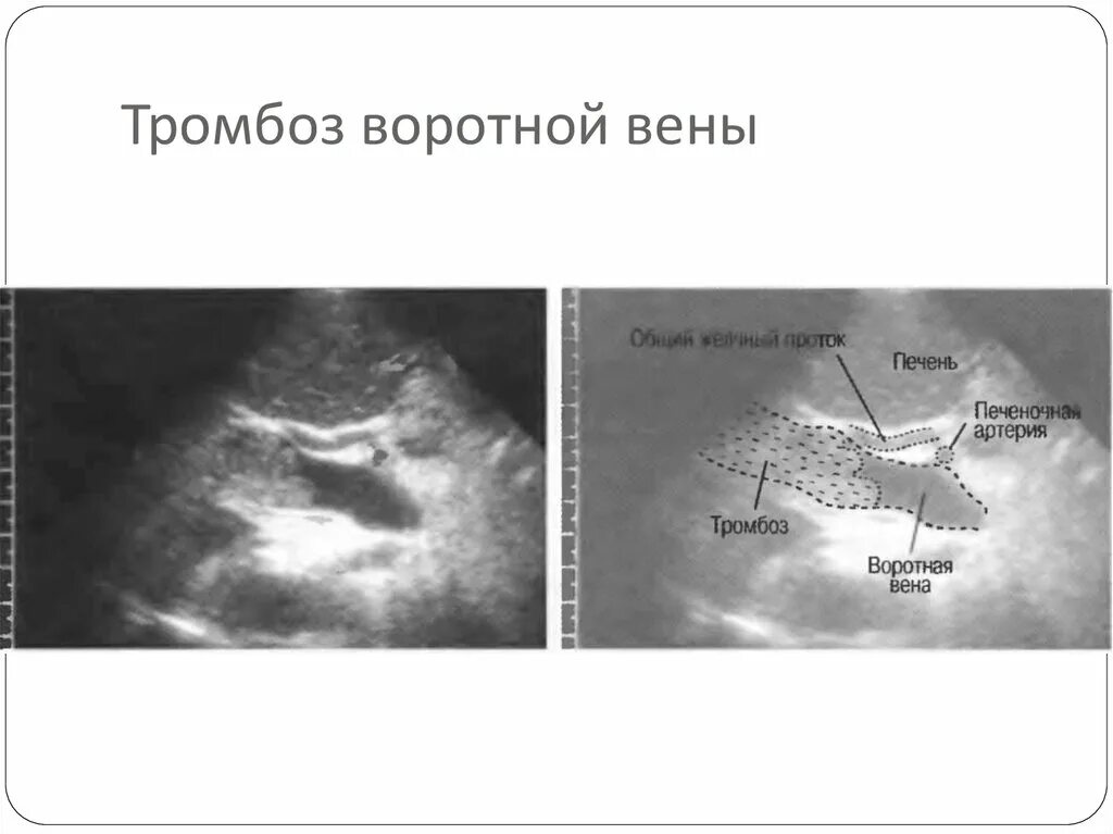 Тромб в воротной Вене на УЗИ. Портальная гипертензия тромбоз воротной вены. УЗИ печени, воротная Вена , холедох. Флеботромбоз снимок УЗИ. Тромбоз вены печени