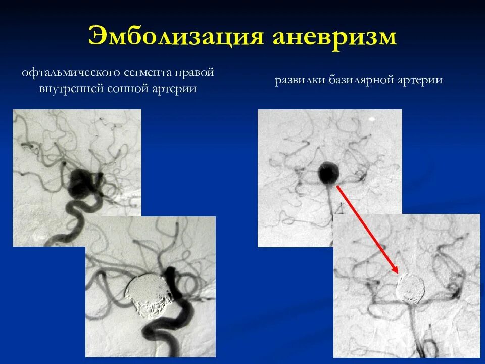 Мешотчатая аневризма базилярной артерии. Мешотчатая аневризма внутренней сонной артерии операция. Эндоваскулярная эмболизация. Базилярная артерия аневризма.