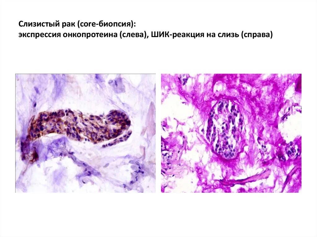 Аденокарцинома Шик реакция. Аденокарцинома желудка микропрепарат Шик реакция. Слизисто-коллоидный раз желудка. Слизистая желудка микропрепарат карцинома. Реакция на слизи