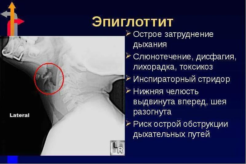 Эпиглоттит симптомы. Эпиглоттит у детей симптомы. Острый эпиглоттит симптомы. Острый эпиглоттит у детей.