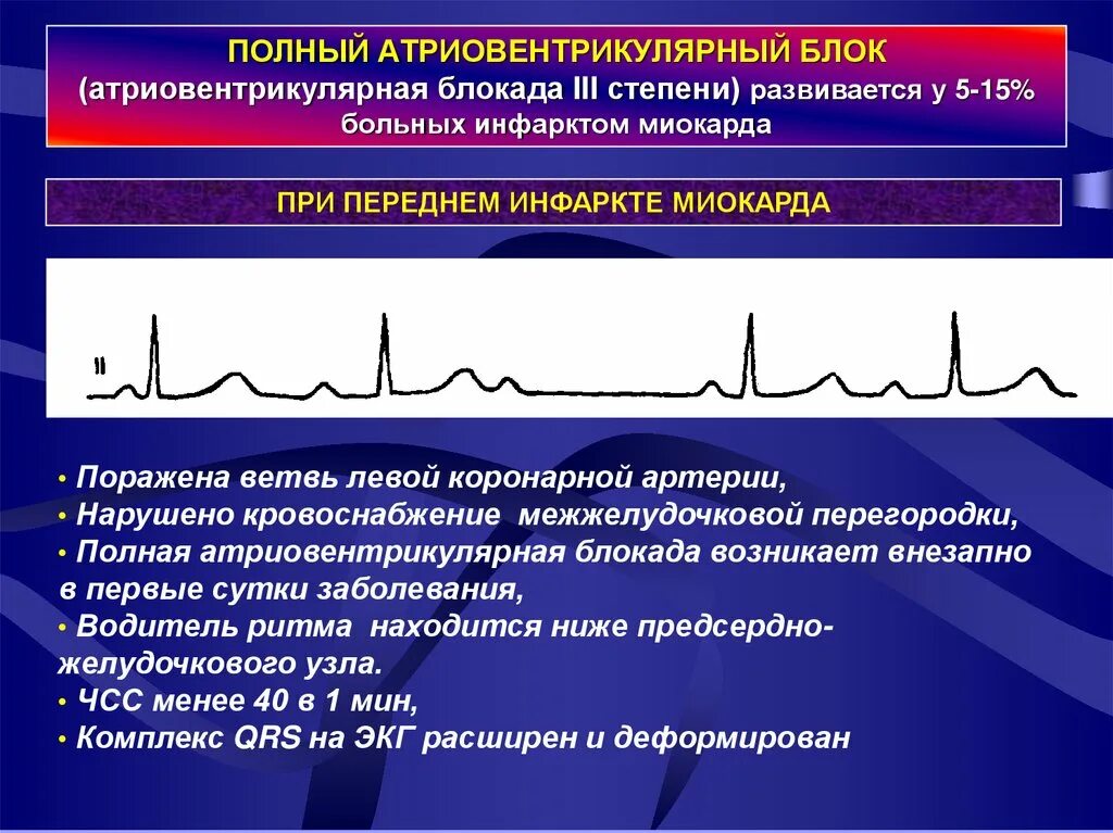 Полная атриовентрикулярная блокада. Атриовентрикулярная блокада инфаркт миокарда. АВ блокада при инфаркте миокарда. Полная атриовентрикулярная блокада III степени.