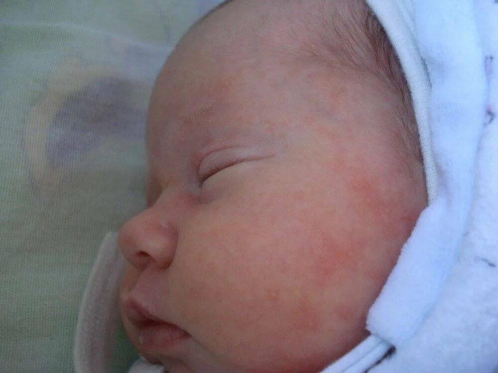Baby Rash on Face - Superfoodsliving.com Baby heat rash, Baby rash, Baby rash on