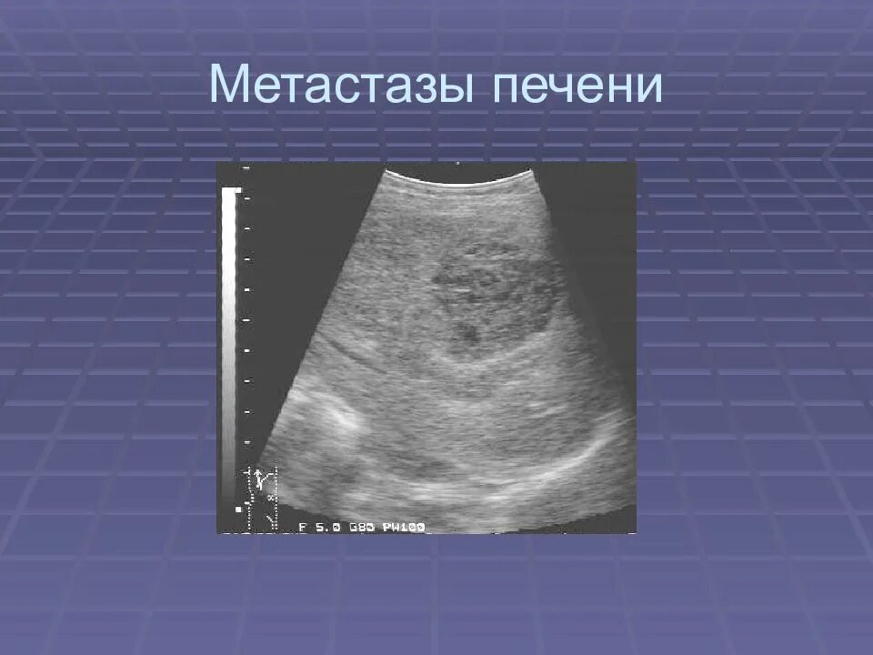 Метастазы в печень мкб. Метастатическое поражение печени УЗИ. Как выглядят метастазы на УЗИ. УЗИ печени при метастазах.