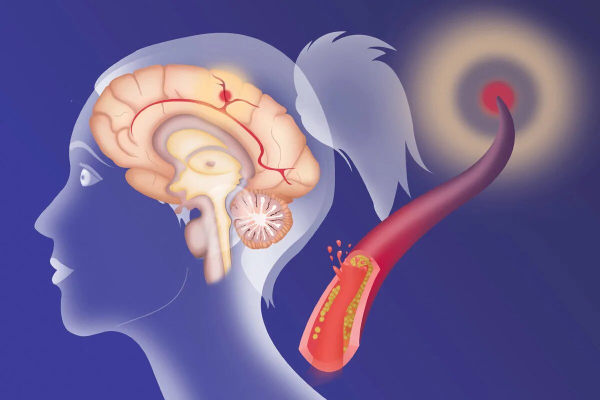 Нарушение кровообращения мозга. Церебральный ишемический криз. Ухудшенное кровообращение головного мозга. Плохое кровообращение мозга симптомы