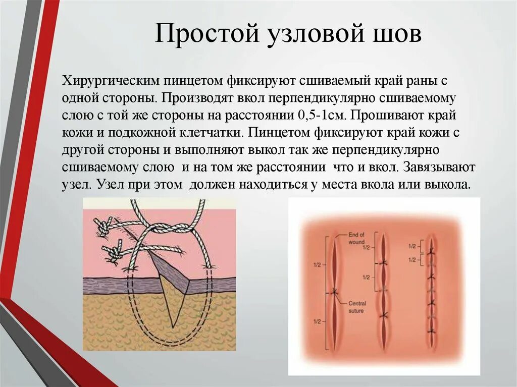 Техника наложения хирургических швов. Простой шов хирургический. Узловой хирургический шов.