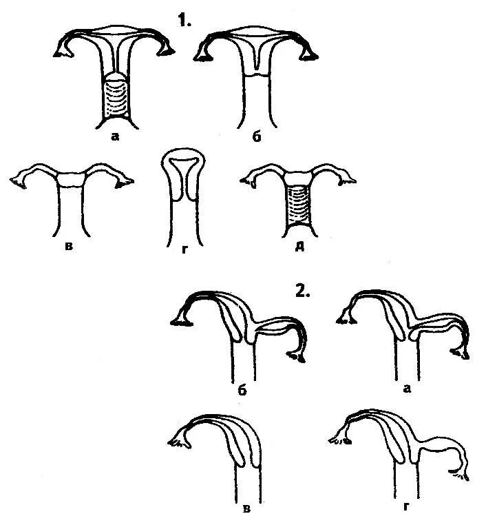 Однорогая и двурогая матка. Аномалия развития матки однорогая. Аномалия развития матки рудиментарный. Рудиментарный Рог матки.