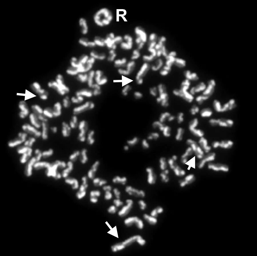 Хроматидные аберрации. Кольцевая хромосома 13. Сестринские хроматидные обмены. Аберрации хроматидного типа.