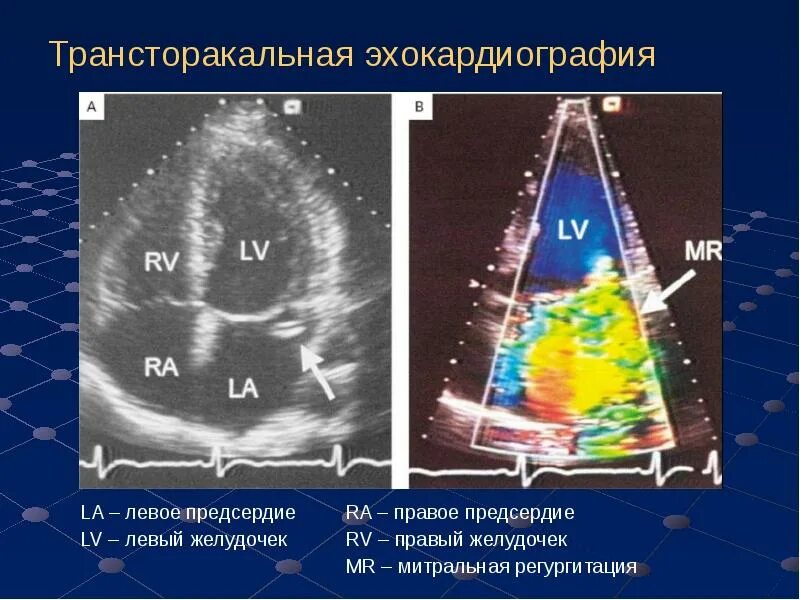 Образование левого предсердия. Трансторакальная ЭХОКГ. Трансторакальная комплексная эхокардиография. Трансторакальная ЭХОКГ методика. Трансторакальная трехмерная эхокардиография.