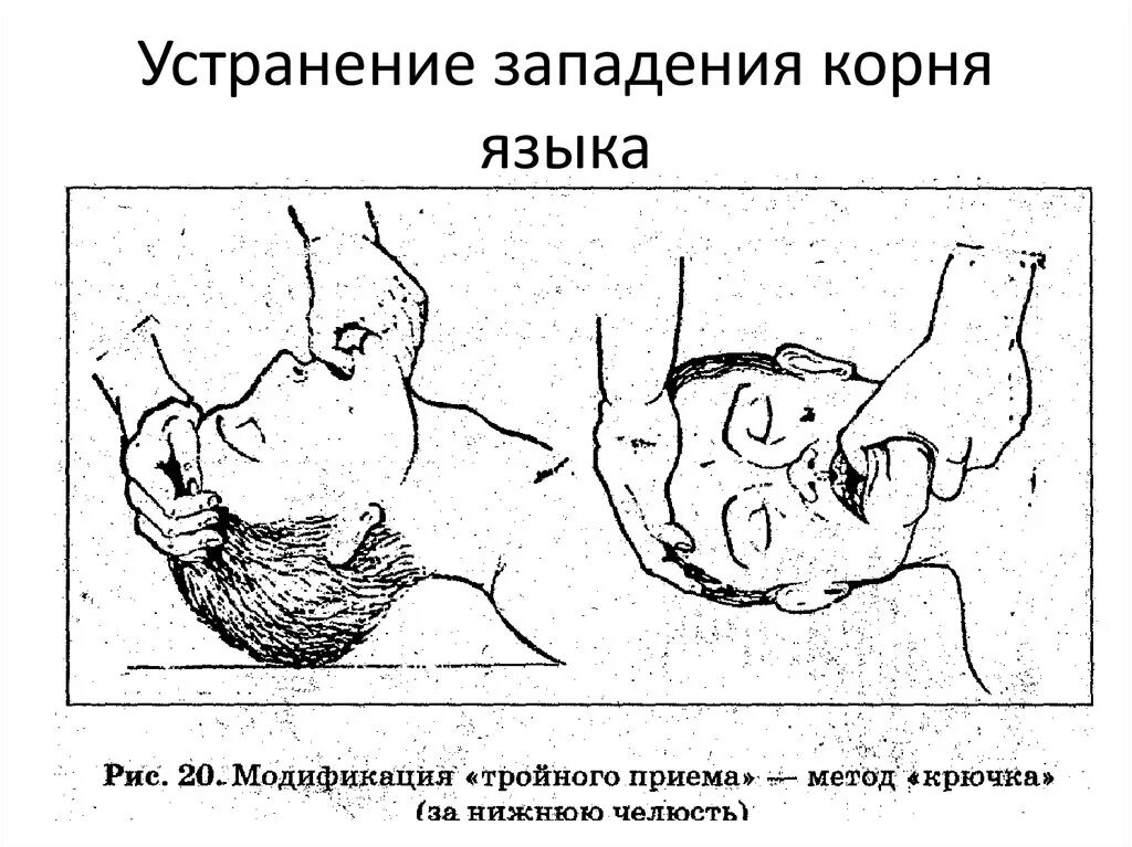 Западание языка помощь. Западение языка первая помощь. меры устраняющие западение корня языка. методы устранения западения языка. устранение западения корня языка.