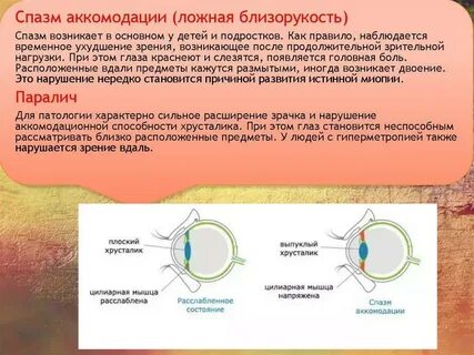 Аккомодация миопия