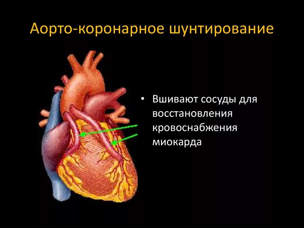 Шунтирование коронарных артерий. Аорто-коронарное шунтирование. Маммарокоронарное шунтирование. Коронарное шунтирование схема. Как делают коронарное шунтирование