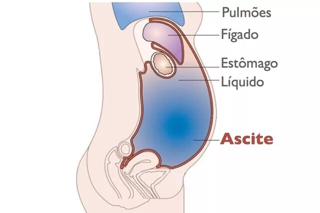 Жидкость в брюшной полости. Жидкость скапливается в животе. Скопление жидкости в полостях. Почему много жидкости на
