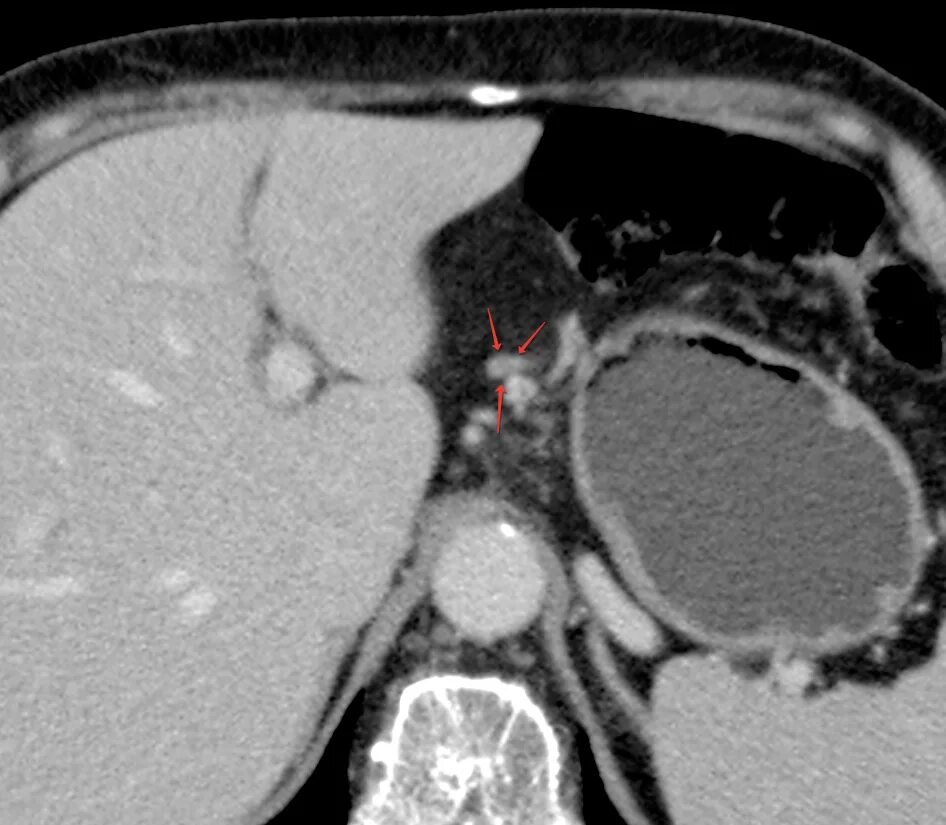 Показывает ли кт онкологию. Показывает ли кт онкологию. Показывает ли кт онкологию. Дупликационная киста желудка кт. Лимфома брюшной полости на кт.