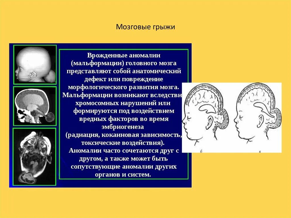 Грыжа мозговых оболочек освобождение нерва. Врожденные черепно мозговые грыжи. Менингоцеле черепно-мозговые грыжи. Базилярная черепно мозговая грыжа. Задняя черепно мозговая грыжа.