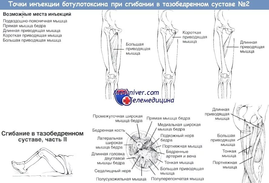 Портняжная мышца в тазобедренном суставе. Точки воздействия на тазобедренный сустав. Сгибание в тазобедренном суставе. Мышцы тазобедренного сустава болят. Какие уколы при болях в тазобедренном суставе