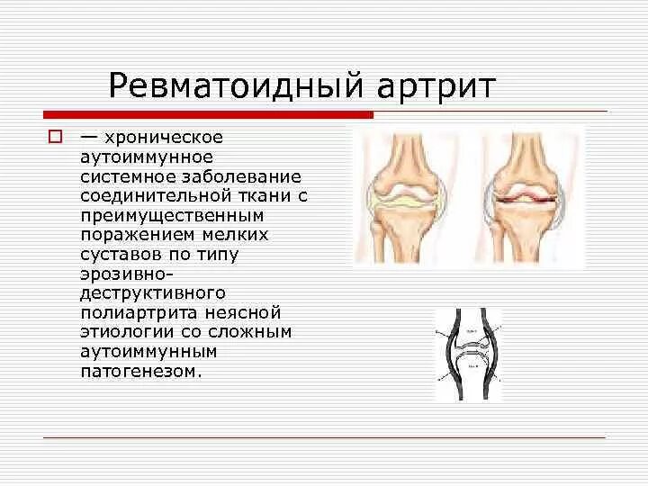 Артрит это аутоиммунное заболевание. Ревматоидный артрит презентация. Артрит это аутоиммунное заболевание. Аутоиммунные заболевания склеродермия синдром. Артрит это аутоиммунное заболевание.