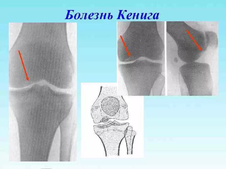 Асептический некроз мыщелков. Рассекающий остеохондрит Кенига. Болезнь Кёнига рассекающий остеохондрит. Кенига болезнь коленного сустава на рентгене. Болезнь Кёнига рассекающий остеохондрит рентген.