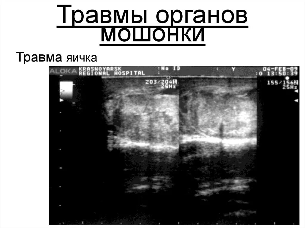 Разрыв половых органов. Травма яичка классификация. закрытая травма органов мошонки.