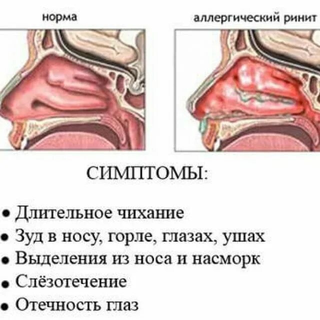 Как избавиться от хронического насморка