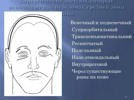 Перелом средней зоны лица
