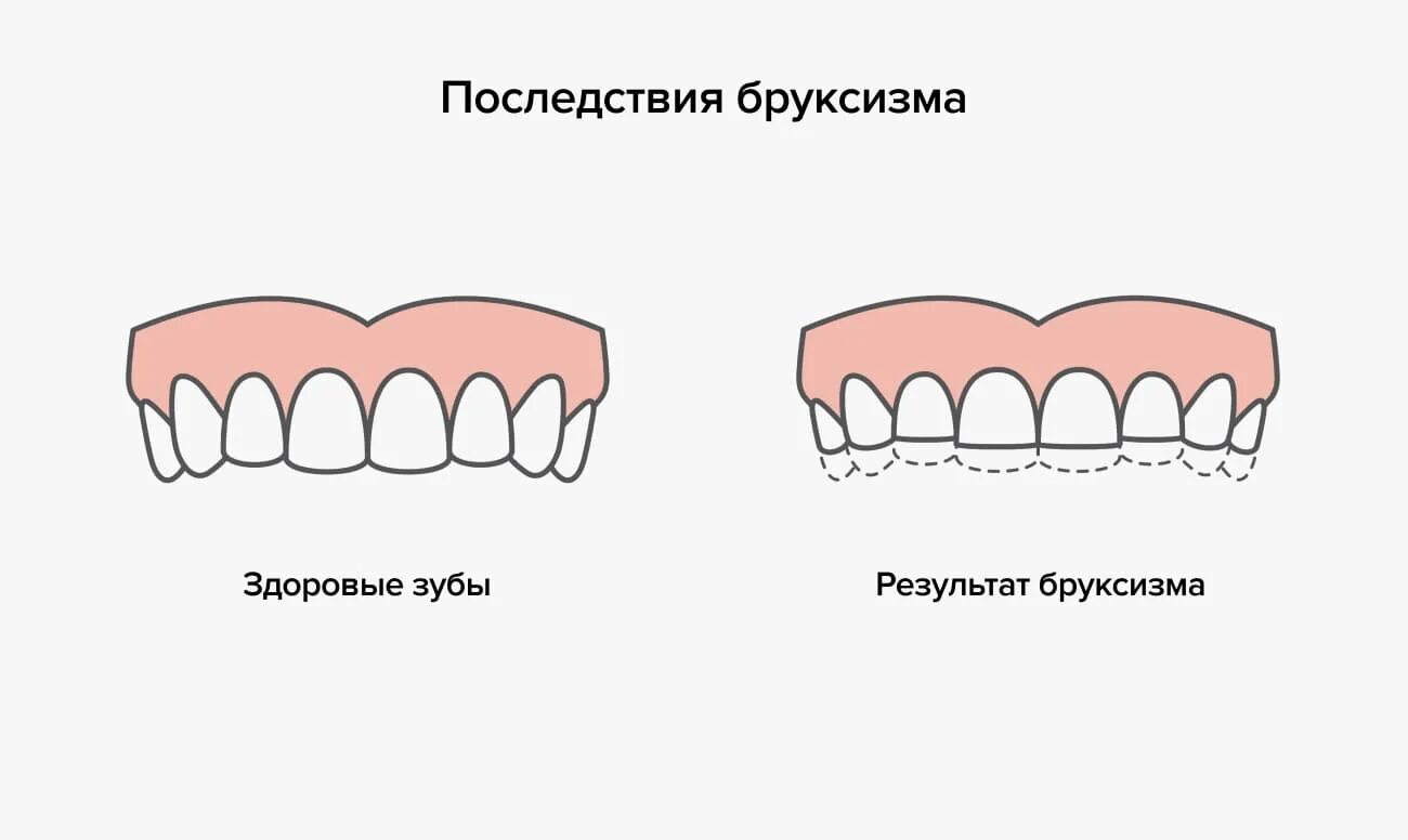 Бруксизм у детей причины. Стираемость зубов бруксизм. бруксизм скрежетание зубами. истирание твердых тканей зуба.